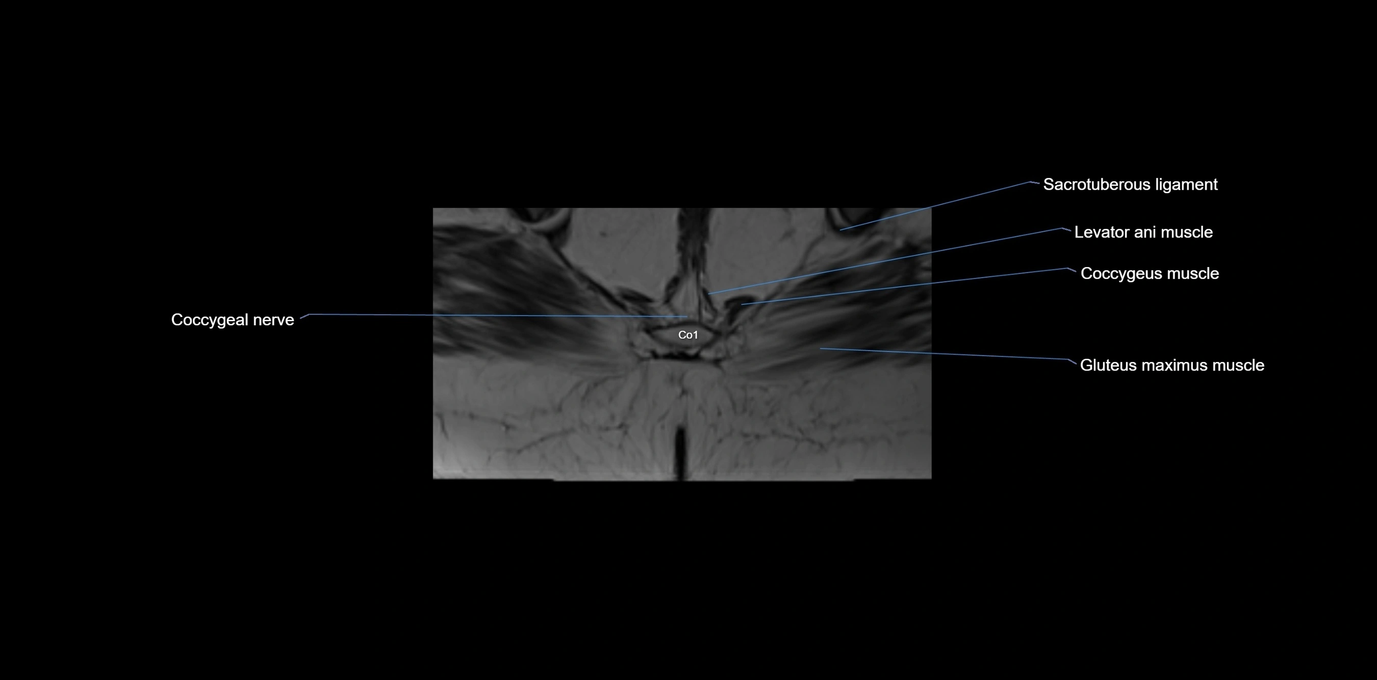 MRI sacrum, coccyx and sacroiliac joint axial cross sectional anatomy 3T  radiology  image-img-00001-00070.webp